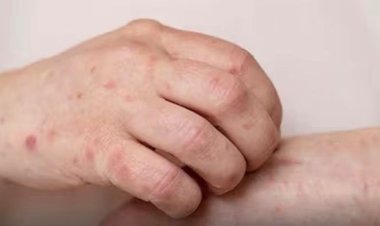 Kasus Campak Meningkat, Kemenkes Terbitkan Edaran Khusus Tingkatkan Kewaspadaan Medis